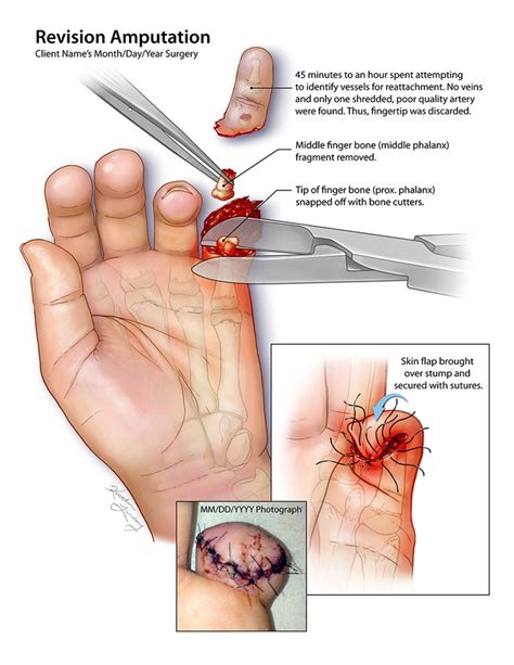 Trial Exhibit Finger Amputation Illustration By Kaitlin Lindsay