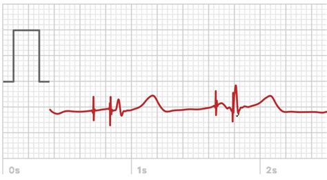 Dual Chamber Pacemaker Ecg