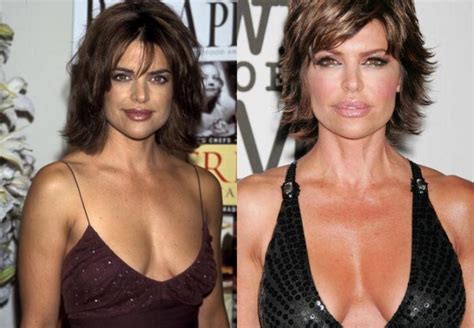 How much Plastic Surgery has Lisa Rinna had over the years?