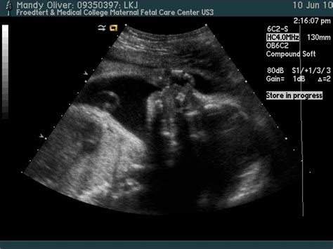 Olive Juice Pyelectasis Ultrasounds And Contractions