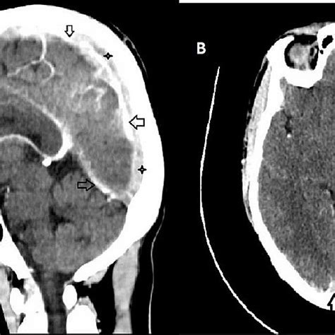 Superior Sagittal Sinus Ct Scan