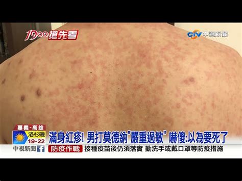 打莫德納後整片紅疹 患者全身紅點癢到爆│中視新聞 20210728