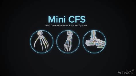 Arthrex Mini CFS Mini Comprehensive Fixation System