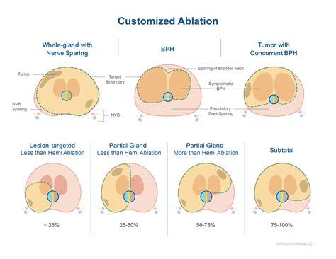 Single Center Retrospective Analysis Of Fifty Two Prostate Cancer