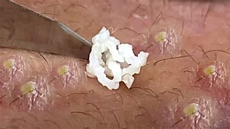 Whitehead Pimple Tv The Best Pimple Popping Videos You Ll Find