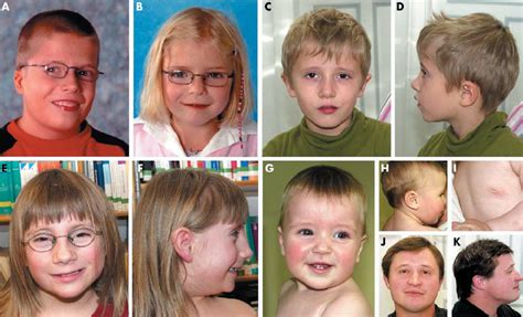 Facial Appearance Of Patients With Typical And Atypical Q