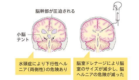 脳神経外科領域のドレナージ ドレーン・カテーテル・チューブ管理 看護roo カンゴルー