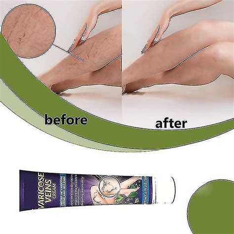 Spider Veins Cream Ointment Blood Vein Veins Vasculitis Varicose Veins