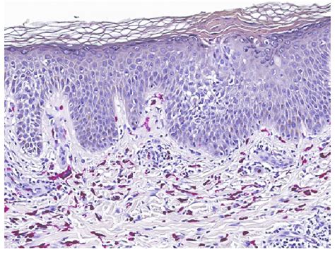 Skin Biopsy With Leder Stain ×15 Highlights Increased Mcs In The