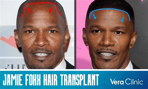 Jamie Foxx Hair Transplant