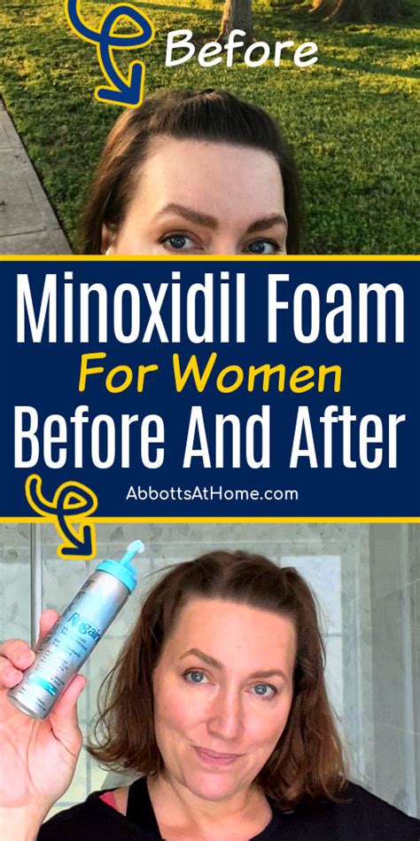 My Minoxidil Results After 2 Years: Rogaine Before And After For Women ...