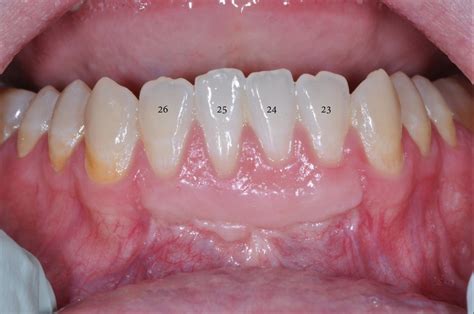 Gingival Graft