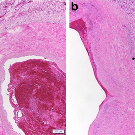 Microscopic Findings Of The Surgical Specimens Using Hematoxylin Eosin