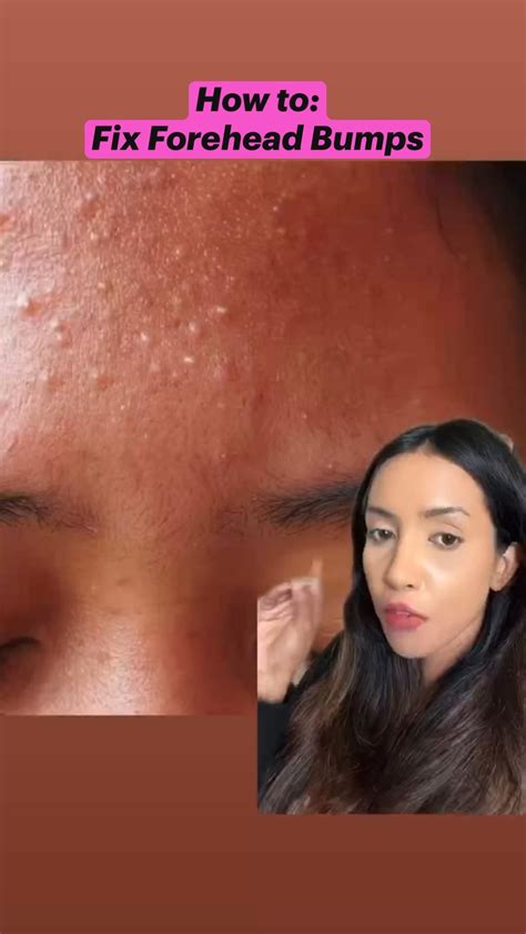 How To Fix Forehead Bumps Or Textured Skin Artofit