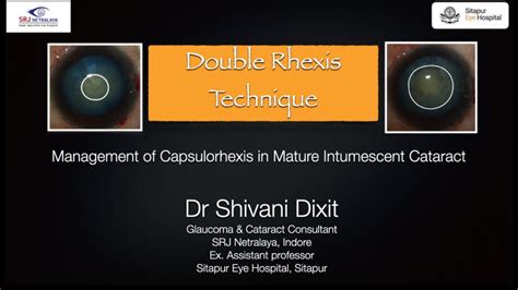 Double Rhexis Technique Step By Step Dr Shivani Dixit Youtube