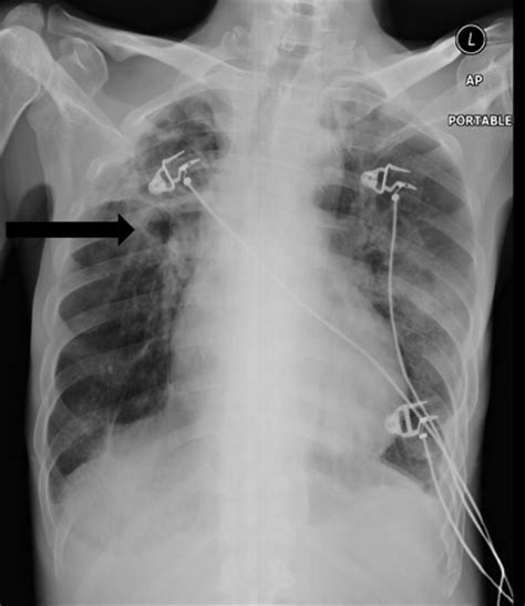 Chest X Ray Anterior Posterior Ap Portable Demonstrating Multiple