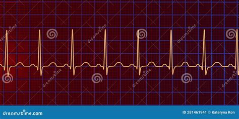 Elektrocardiogram Ecg Met Sinus Tachycardie 3d Illustratie Stock