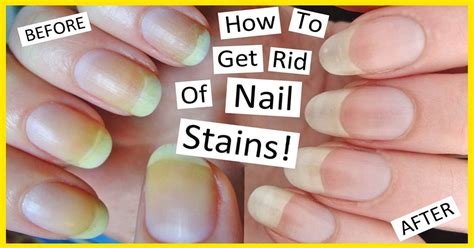 12 Easy Ways To Get Rid Of Yellow Nails At Home - Baggout