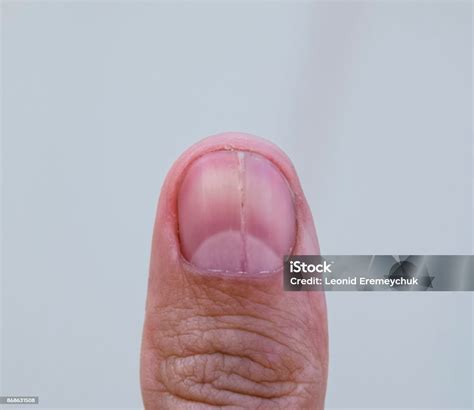 Unha Partida No Meio - Foto de Bifurcada Unha No Polegar Dilatação Da Unha Patologia ...