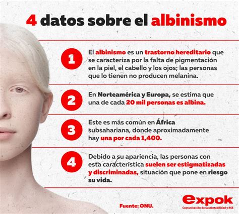 4 Datos Sobre El Albinismo