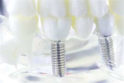 Dental Titanium Tooth Implant Stock Image - Image of root, dent: 103558527