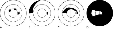 Visual field defects - American Academy of Ophthalmology