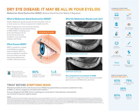 Dry Eye Disease It May Be All In Your Eyelids That Contribute To Mgd