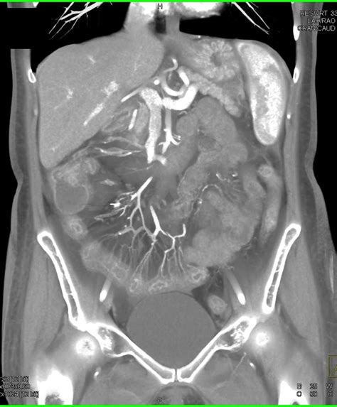 Severe Enteritis Involving The Small Bowel Due To Graft Vs Host Disease