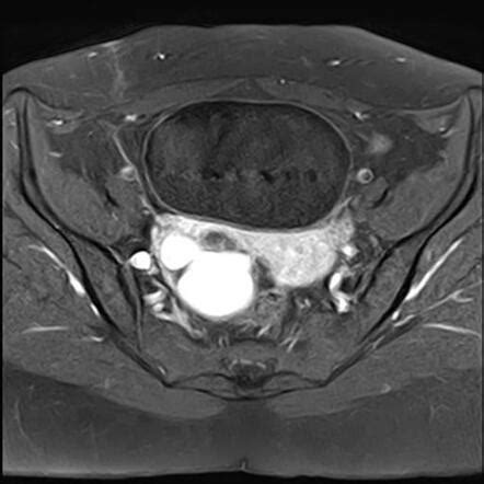 Ovarian Endometriomas Image Radiopaedia Org