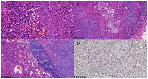 Phosphaturic Mesenchymal Tumor In Right Thigh Cases Report And