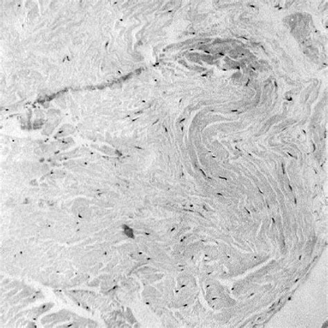 Histology of ruptured Achilles tendon. Note the disordered appearance ...