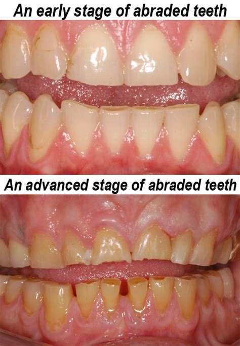 Treatment of broken or abraded teeth | Ralev Dental Clinic