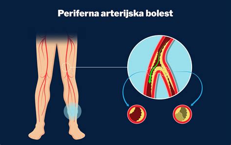 Na Koji Način Bolest Perifernih Arterija Ugrožava Srce I Mozak Eklinika