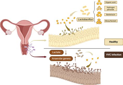 Vaginal Candidiasis Histology