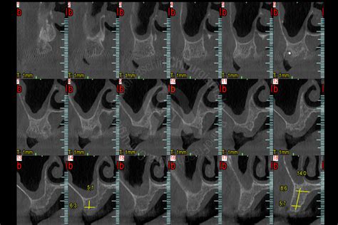 Maxillary Sinus Grafting Fraschini Chirurgia Orale