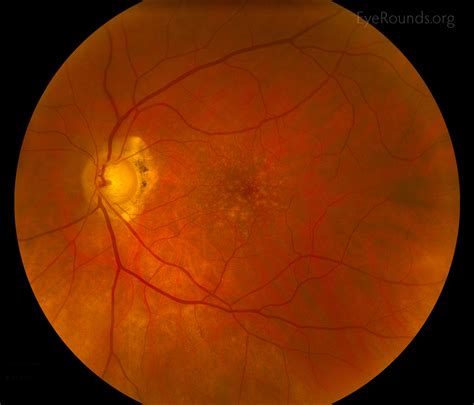 Atlas Entry Ocular Melanocytosis