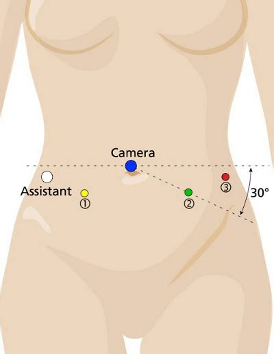 Laparoscopic Sacrocolpopexy