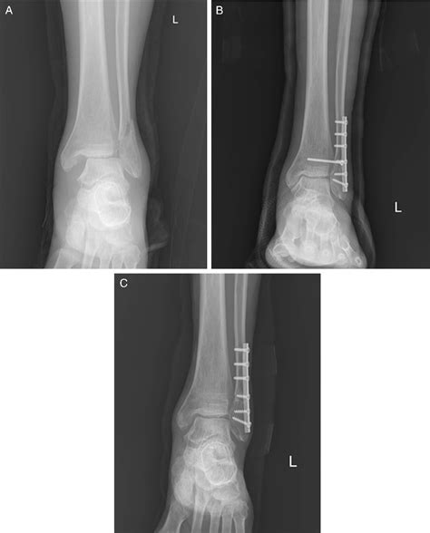 Figure 1 From A Comparison Of Screw Fixation And Suture Button Fixation