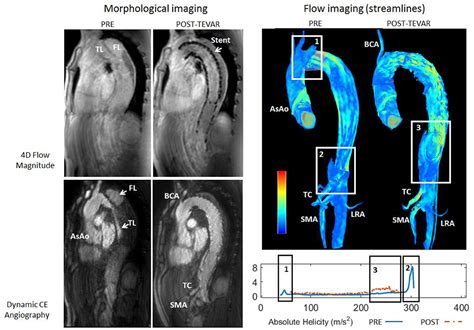 Frontiers Hemodynamic Changes Before And After Endovascular Treatment