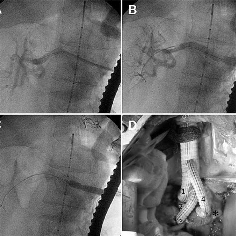 Postoperative Cta A Intra Aortic Viabahn Stent Graft Behind The