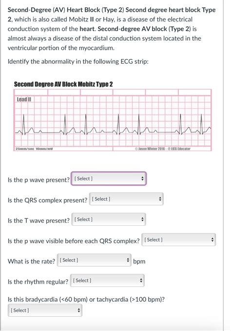 Solved Second-Degree (AV) Heart Block (Type 2) Second degree | Chegg.com