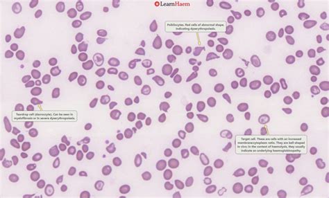 α Thalassaemia Learnhaem Haematology Made Simple