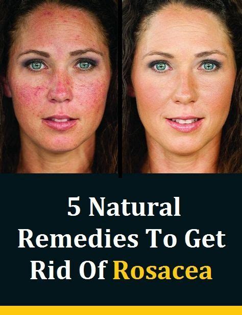 5 Natural Remedies To Get Rid Of Rosacea In 2020 Rosacea Natural