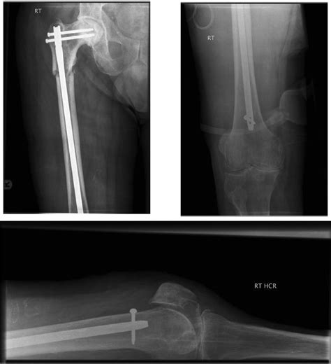 Ap And Lateral Views Of Pelvis And Knee With Nail And Locking Screws