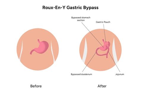 Cirurgia de bypass gástrico para perda de peso | Vetor Premium