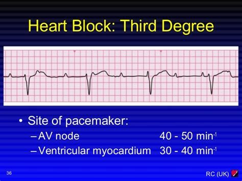 Acls Heart Block Algorithm