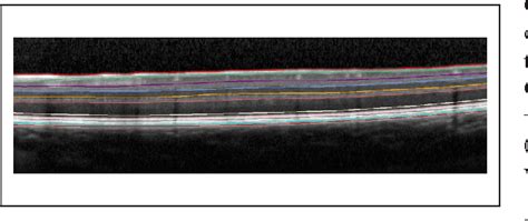 Figure From Sex Differences And Subclinical Retinal Injury In