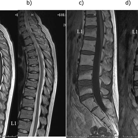 Magnetic Resonance Imaging Findings For The Thoracic And Lumbar Spine