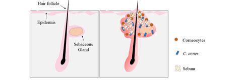 Acne Pathogenesis In Hair Follicle I And Comparison With Normal Hair