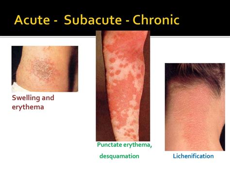 Dermatitis